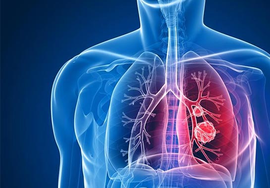 Governo Federal lança Plano Nacional Pelo Fim da Tuberculose