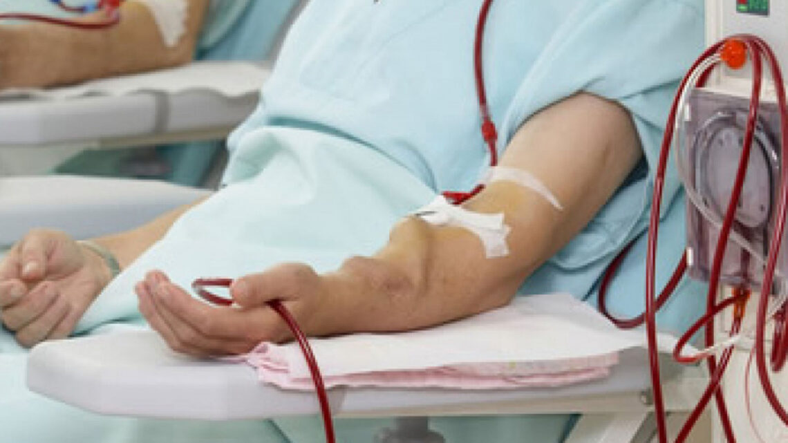 5 Perguntas e respostas sobre a fístula arteriovenosa para hemodiálise