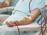 5 Perguntas e respostas sobre a fístula arteriovenosa para hemodiálise