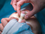 “Rinoplastia Caseira”: cirurgião plástico fala sobre caso de homem que tentou operar o próprio nariz