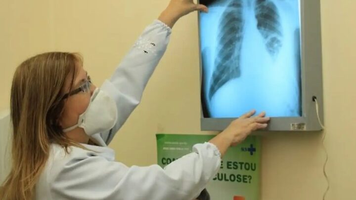 Custos da tuberculose no Brasil foram superiores a US$ 1,3 bilhão entre 2015 e 2022